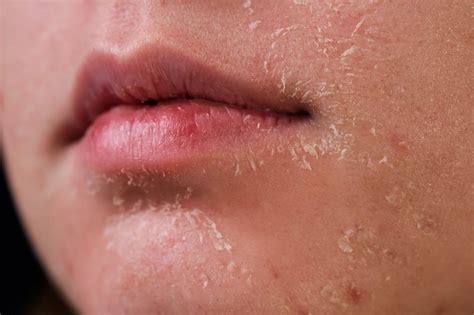 WHAT CAUSES FLAKY SKIN AFTER FACE WASH? – Deyga Organics
