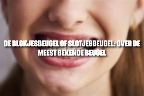 De blokjesbeugel of slotjesbeugel: over de meest bekende beugel
