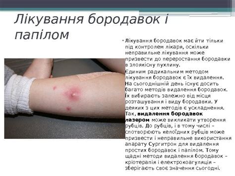 Бородавки. Причини появи бородавок. Види бородавок. Виконала учениця