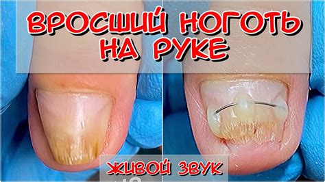 Вросший ноготь / Скрученный ноготь / Титановая нить установка / Грибок ...