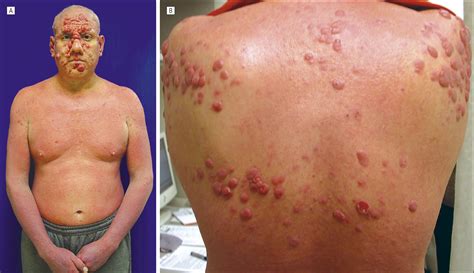 Lymphoma Skin Cancer Symptoms