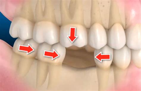 consecuencias puede tener la perdida de  diente