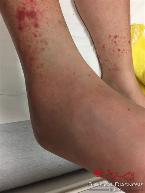 Petechiae