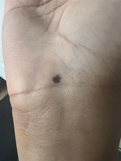 Does this look like melanoma? : r/Melanoma