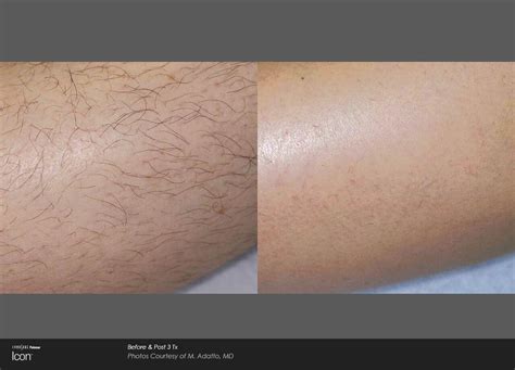 Laser Hair Removal — REJUVA Medi Spa