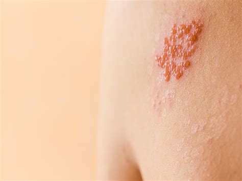 Viral Infections - Orijine - SKIN, HAIR AND WELLNESS