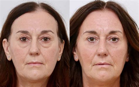 blepharoplasty        bright  bellezie