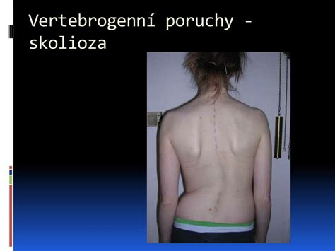 PPT - Vertebrogenní poruchy - skolioza PowerPoint Presentation, free ...