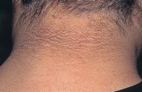 Acanthosis Nigricans Causes, Symptoms, Treatment, 58% OFF