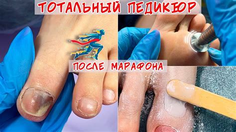 Полный педикюр / Онихолизис ногтей и синяк под ногтем - YouTube