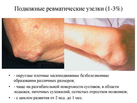 Ревматическая лихорадка. Митральный стеноз - презентация онлайн