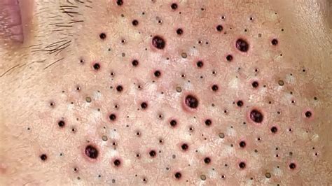The Unbelievable Blackhead Removal Secret Celebrities Don't Want You to Know - yyv3bsa