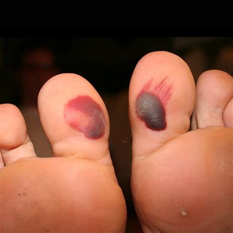 Blood Blister On Foot - Do's and Don'ts