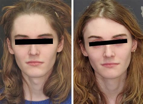 transgender surgery results