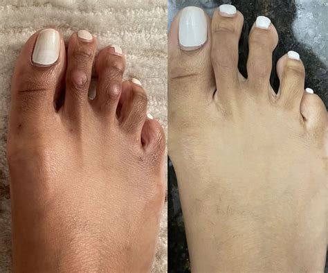 Before and After Surgery Pictures | Best Foot Doctor, NY
