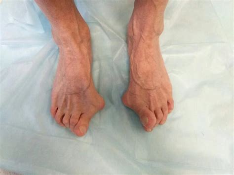 Hallux valgus, вальгусная деформация стоп | Сайт доктора Третьякова А.А.