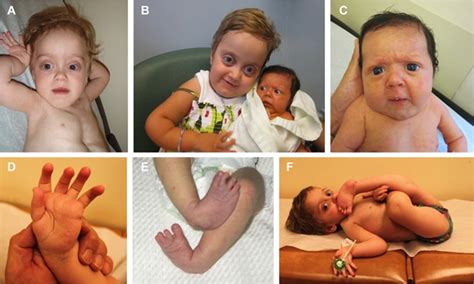 Ehlers Danlos Syndrome Medlineplus Genetics - vrogue.co