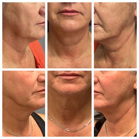 sofwave dermatologist  lake forest ca saddleback dermatology