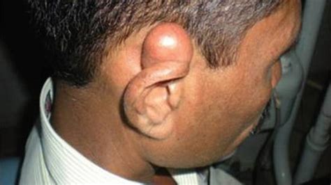 painful cyst  ear