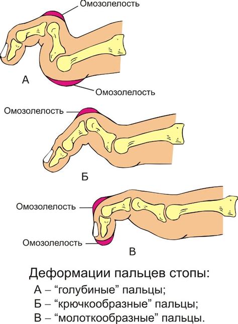 Центр здоровья ног / Деформации пальцев стопы