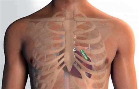 Loop Recorder Insertion - Cardiology Tasmania