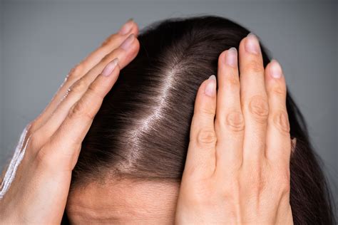 diffuse thinning signs symptoms treatment options