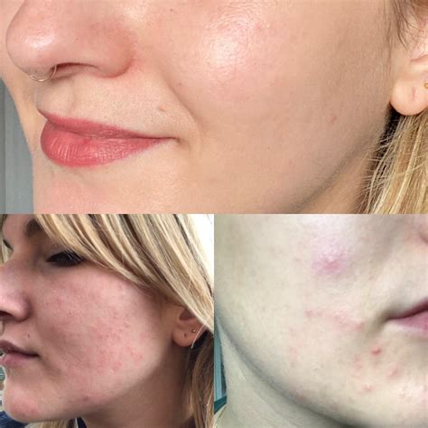 dehydrated skin