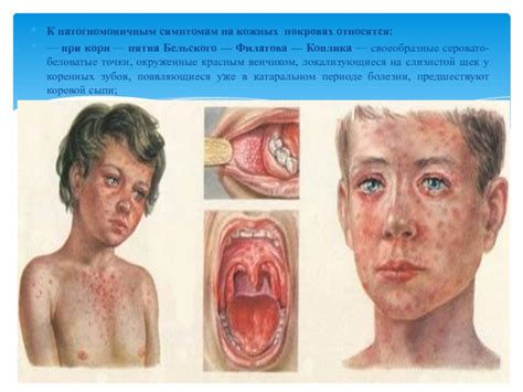 ЭКЗАНТЕМЫ презентация, доклад