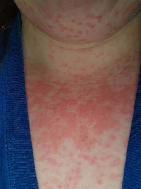 Apparently I'm allergic to the new meds I'm taking : r/Wellthatsucks