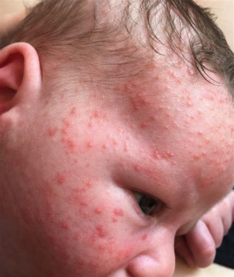 Neonatal Acne Wikipedia