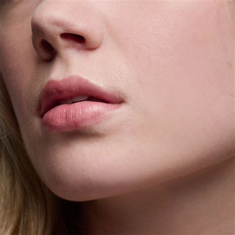 Acne Scarring | Scarring Treatment | R Clinic