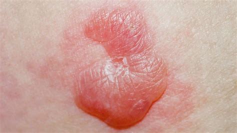 types  skin lesions pictures    artofit