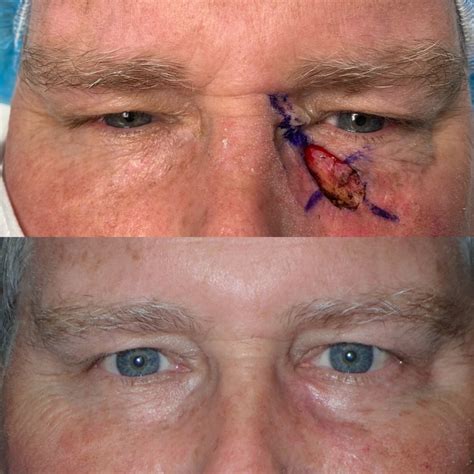 Eyelid Cancer Reconstruction - Cameron Nabavi, MD