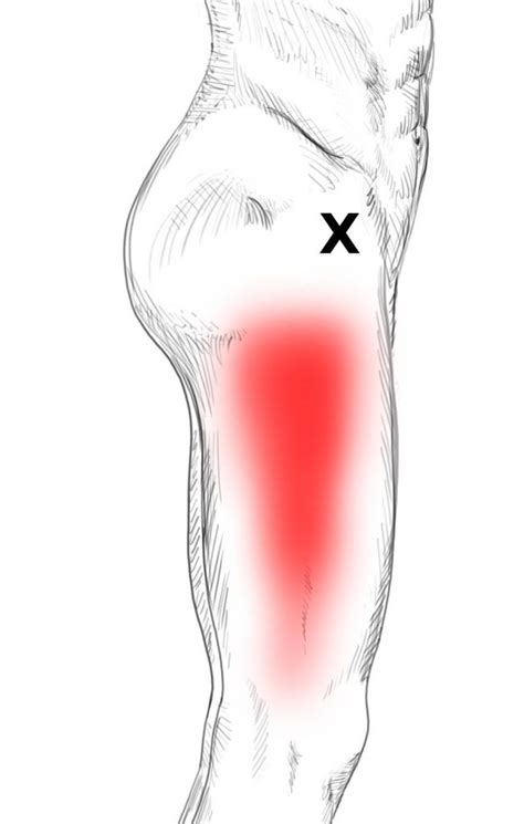 Pain And Injury In The Tensor Fasciae Latae Muscles Stock Illustration ...