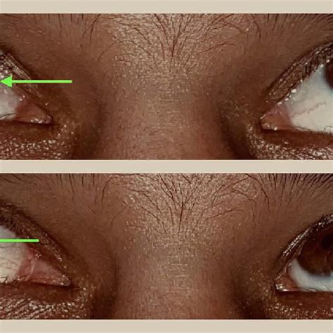 patient   intermittent divergent squint