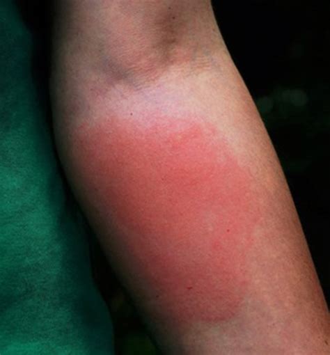 Yellow Jacket Wasp Sting Allergic Reaction at Arnetta Parker blog