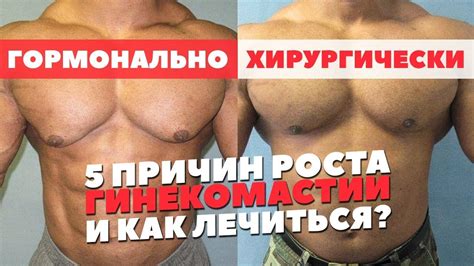 ГИНЕКОМАСТИЯ КАК ИЗБАВИТЬСЯ (Гино на Курсе ААС или подростковая) - YouTube