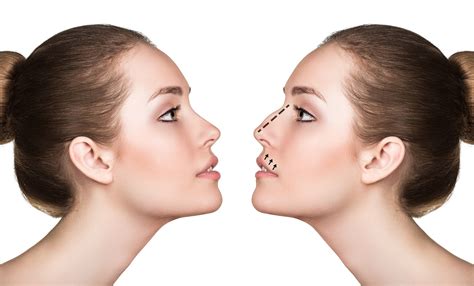 Types Of Noses For Nose Jobs at Matilda Neil blog