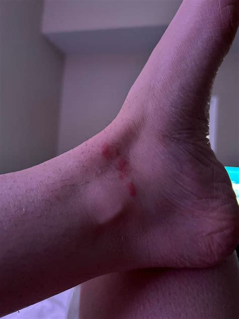 Any ideas? Itchy bites almost mirroring each other on both ankles