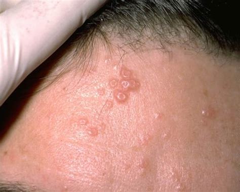 Molluscum Contagiosum Causes Symptoms Transmissions R - vrogue.co