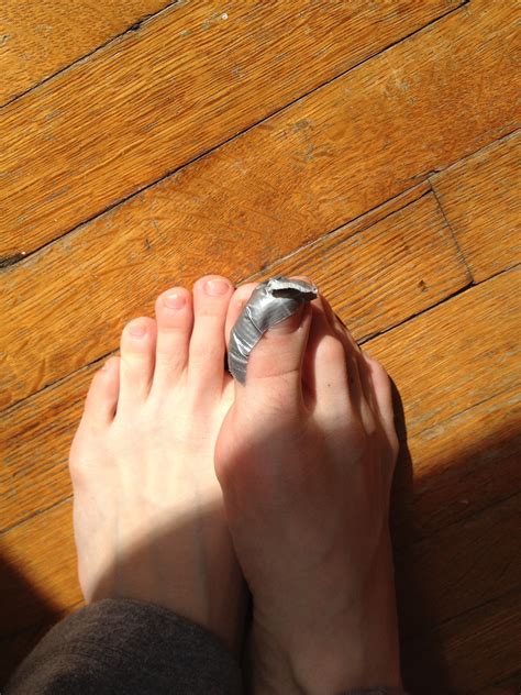 Duct Tape To Get Rid Of Warts at Alicia Barrenger blog