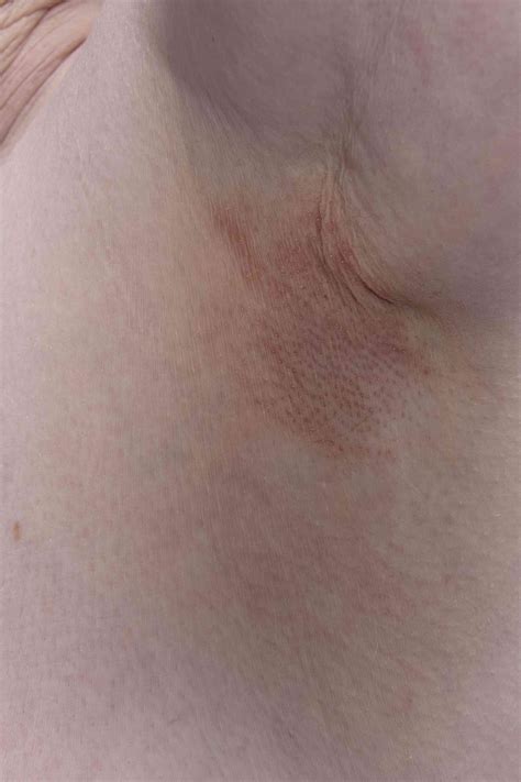 What's Causing Your Underarm Rash?