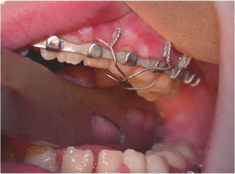 intermaxillary fixation   primary  mixed dentition oral