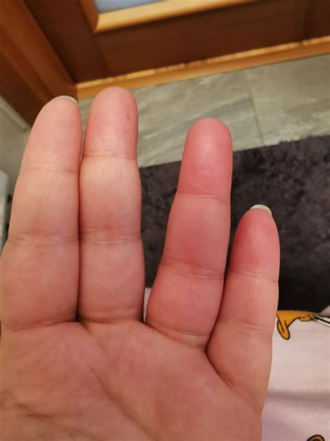 Could this be erythromelalgia? : r/Erythromelalgia