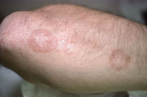 eczema rash circular  dustin richards blog