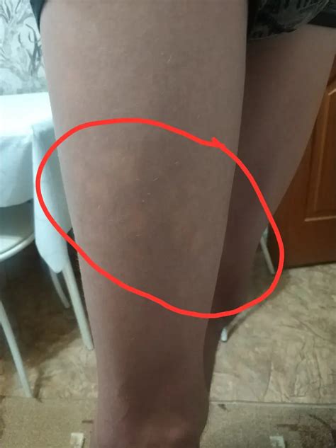 Белые пятна на ногах Моему брату 15 лет. Заметил, что у него иногда ...