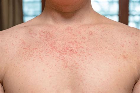 stages  syphilis infection