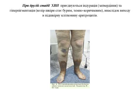 Догляд за хворими з хірургічними захворюваннями і ушкодженнями кінцівок ...
