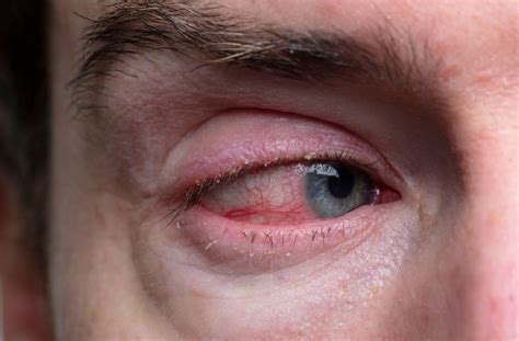 Pink Eye Quiz - Doquizzes