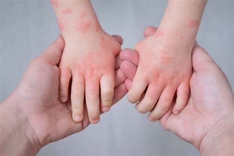 Eczema in Children: Symptoms, Causes, Treatment - SWCMG